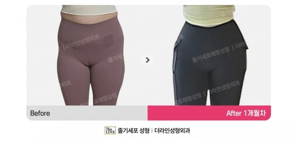 Waist to Saddlebags, before and after 1 month at Seoul Lipo Center