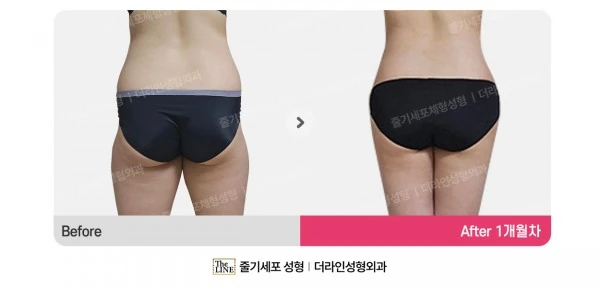 Waist to Saddlebags before-and-after photo, before surgery - TheLINE Plastic Surgery