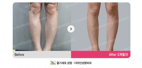Calf Botox before-and-after photo, before surgery - TheLINE Plastic Surgery
