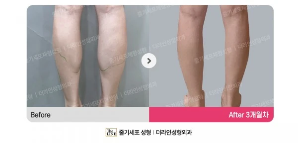 Calf Botox before-and-after photo, before surgery - TheLINE Plastic Surgery
