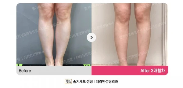 Calf Botox before-and-after photo, before surgery - TheLINE Plastic Surgery
