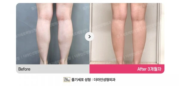 Calf Botox before-and-after photo, before surgery - TheLINE Plastic Surgery