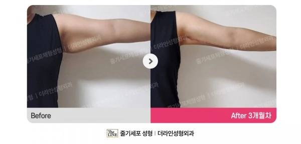 Arm Lift + Arm Liposuction, before and after 3 months at Seoul Lipo Center