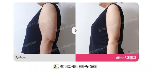 Arm Lift + Arm Liposuction before-and-after photo, before surgery - TheLINE Plastic Surgery