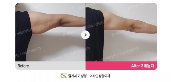 Arm Lift + Arm Liposuction before-and-after photo, before surgery - TheLINE Plastic Surgery
