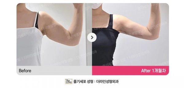Arm Lift + Arm Liposuction, before and after 1 month at Seoul Lipo Center