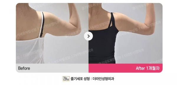 Arm Lift + Arm Liposuction before-and-after photo, before surgery - TheLINE Plastic Surgery