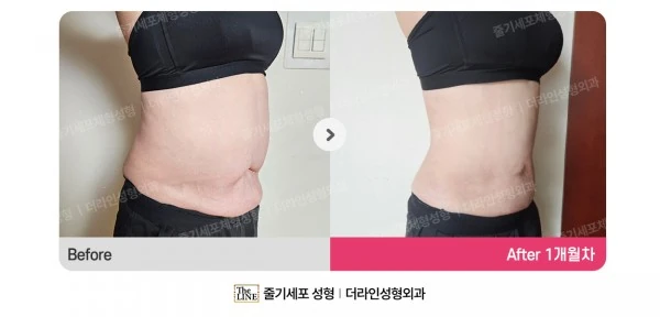 Abdominal Lift before-and-after photo, before surgery - TheLINE Plastic Surgery