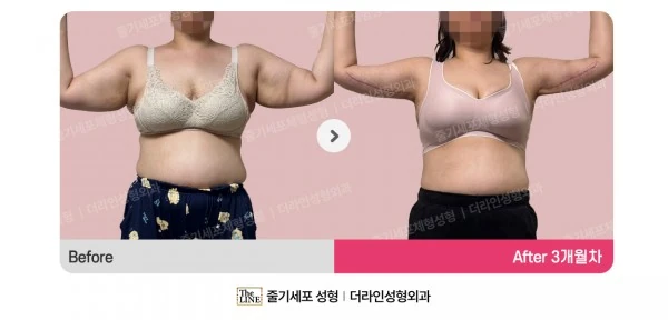 Arm Lift before-and-after photo, before surgery - TheLINE Plastic Surgery