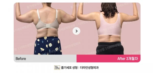 Arm Lift before-and-after photo, before surgery - TheLINE Plastic Surgery