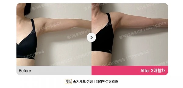 Mini Arm Lift before-and-after photo, before surgery - TheLINE Plastic Surgery