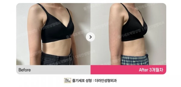 Mini Arm Lift before-and-after photo, before surgery - TheLINE Plastic Surgery