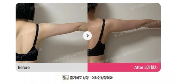 Mini Arm Lift before-and-after photo, before surgery - TheLINE Plastic Surgery