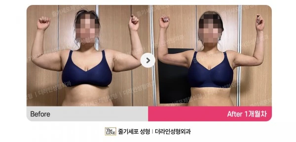 Arm Lift + Arm Liposuction, before and after 1 month at Seoul Lipo Center