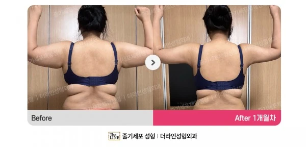 Arm Lift + Arm Liposuction before-and-after photo, before surgery - TheLINE Plastic Surgery