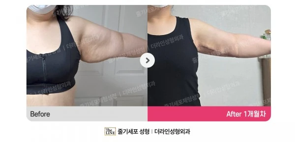 Arm Lift before-and-after photo, before surgery - TheLINE Plastic Surgery