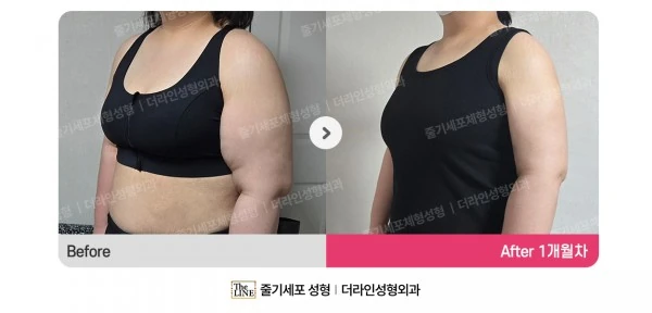 Arm Lift before-and-after photo, before surgery - TheLINE Plastic Surgery