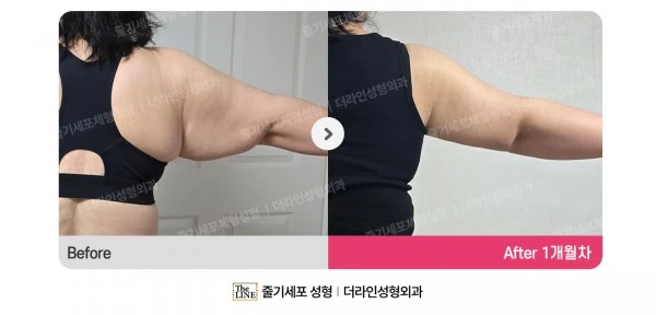 Arm Lift before-and-after photo, before surgery - TheLINE Plastic Surgery
