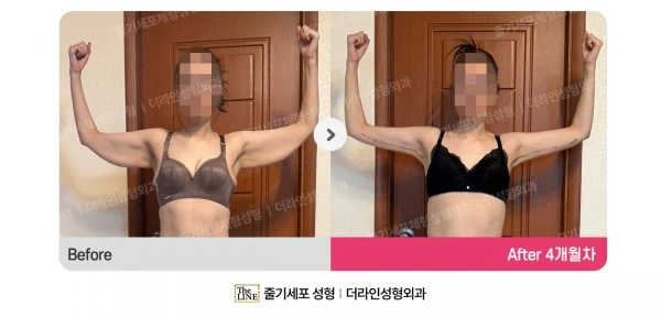 Arm Lift + Arm Liposuction, before and after 4 months at Seoul Lipo Center
