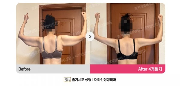 Arm Lift + Arm Liposuction before-and-after photo, before surgery - TheLINE Plastic Surgery
