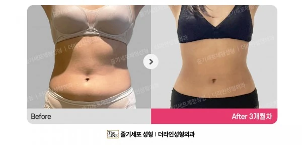 Abdominal Liposuction, before and after 3 months at Seoul Lipo Center