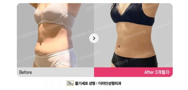 Abdominal Liposuction before-and-after photo, before surgery - TheLINE Plastic Surgery