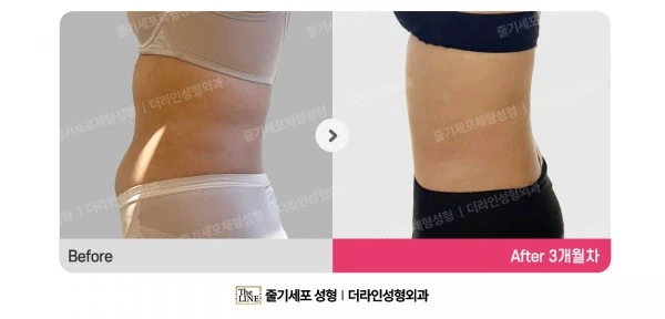 Abdominal Liposuction before-and-after photo, before surgery - TheLINE Plastic Surgery