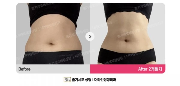 Abdominal Liposuction, before and after 2 months at Seoul Lipo Center