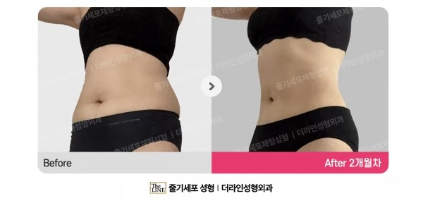 Abdominal Liposuction before-and-after photo, before surgery - TheLINE Plastic Surgery