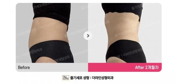 Abdominal Liposuction before-and-after photo, before surgery - TheLINE Plastic Surgery