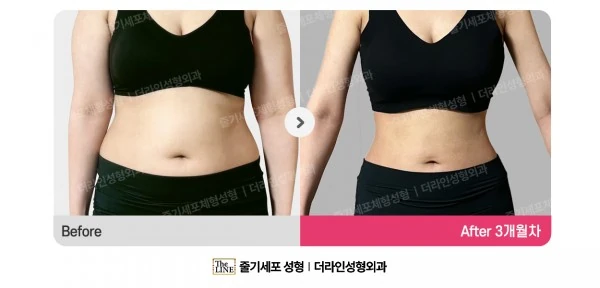 Abdominal Liposuction, before and after 3 months at Seoul Lipo Center