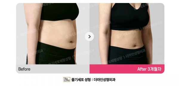 Abdominal Liposuction before-and-after photo, before surgery - TheLINE Plastic Surgery