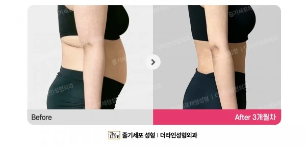 Abdominal Liposuction before-and-after photo, before surgery - TheLINE Plastic Surgery