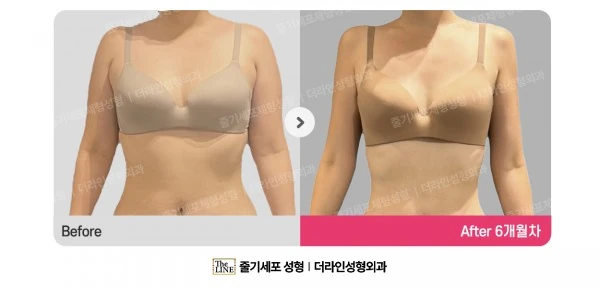 Arm Liposuction, before and after 6 months at Seoul Lipo Center