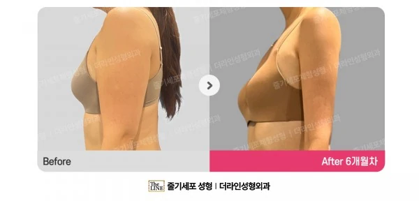 Arm Liposuction before-and-after photo, before surgery - TheLINE Plastic Surgery