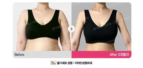 Arm Liposuction, before and after 3 months at Seoul Lipo Center