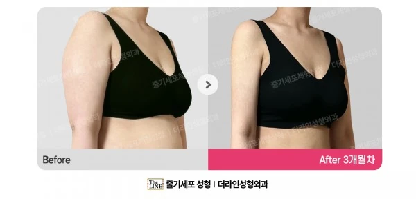 Arm Liposuction before-and-after photo, before surgery - TheLINE Plastic Surgery