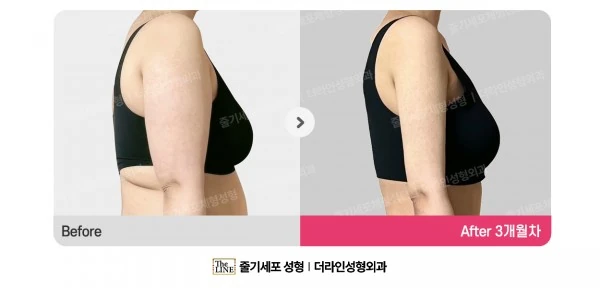 Arm Liposuction before-and-after photo, before surgery - TheLINE Plastic Surgery