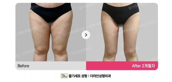 Thigh Liposuction, before and after 2 months at Seoul Lipo Center