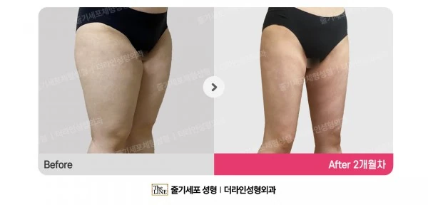 Thigh Liposuction before-and-after photo, before surgery - TheLINE Plastic Surgery