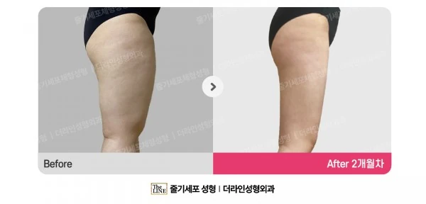 Thigh Liposuction before-and-after photo, before surgery - TheLINE Plastic Surgery