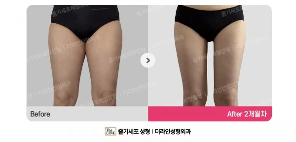Thigh Liposuction, before and after 2 months at Seoul Lipo Center
