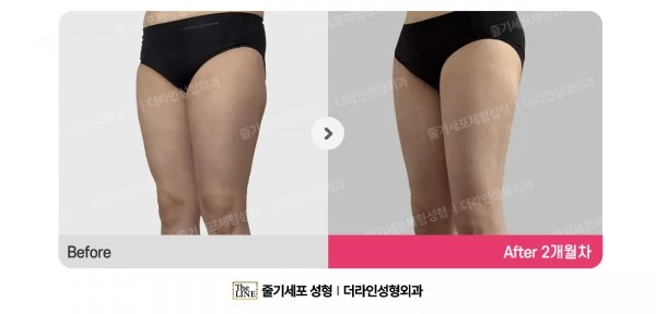 Thigh Liposuction before-and-after photo, before surgery - TheLINE Plastic Surgery