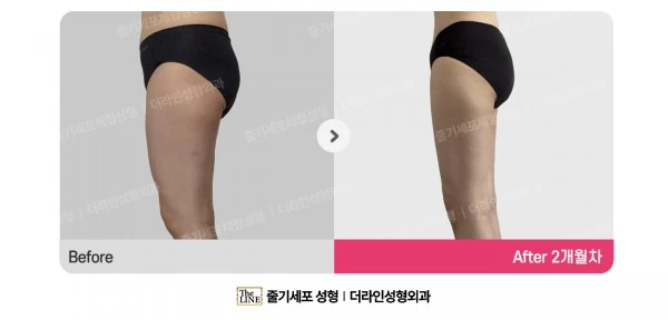 Thigh Liposuction before-and-after photo, before surgery - TheLINE Plastic Surgery
