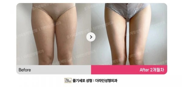 Thigh Liposuction, before and after 2 months at Seoul Lipo Center