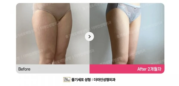 Thigh Liposuction before-and-after photo, before surgery - TheLINE Plastic Surgery
