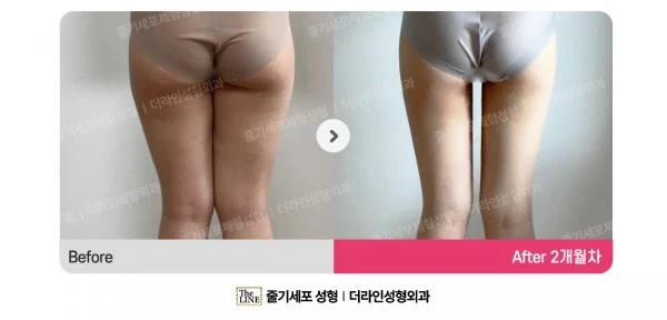 Thigh Liposuction before-and-after photo, before surgery - TheLINE Plastic Surgery