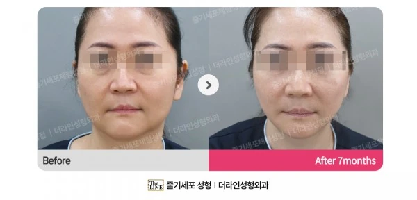 SVF Deep Plane Facelift before-and-after photo, before surgery - TheLINE Plastic Surgery
