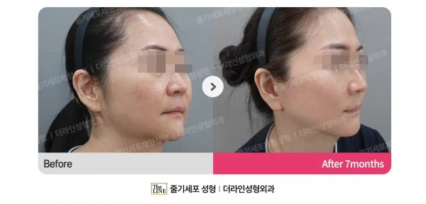 SVF Deep Plane Facelift before-and-after photo, before surgery - TheLINE Plastic Surgery