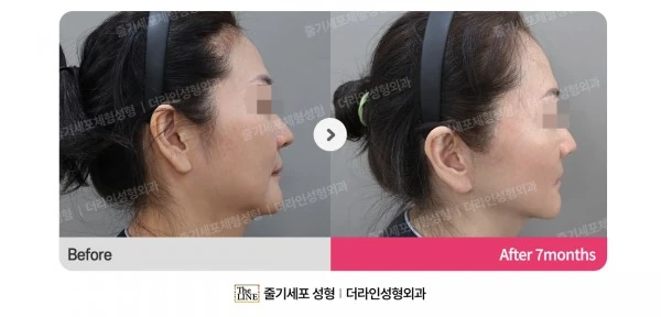 SVF Deep Plane Facelift before-and-after photo, before surgery - TheLINE Plastic Surgery